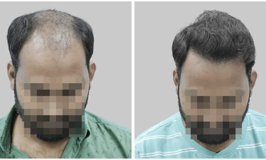  Unlocking Confidence: The Best Hair Transplant Clinic in Delhi