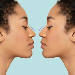 Redefining Self-Expression The Artistry of Rhinoplasty in Facial Transformation