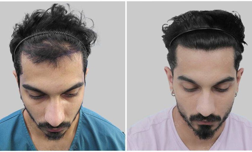  Unlocking Confidence: The Journey of Hair Transplant in Gurgaon