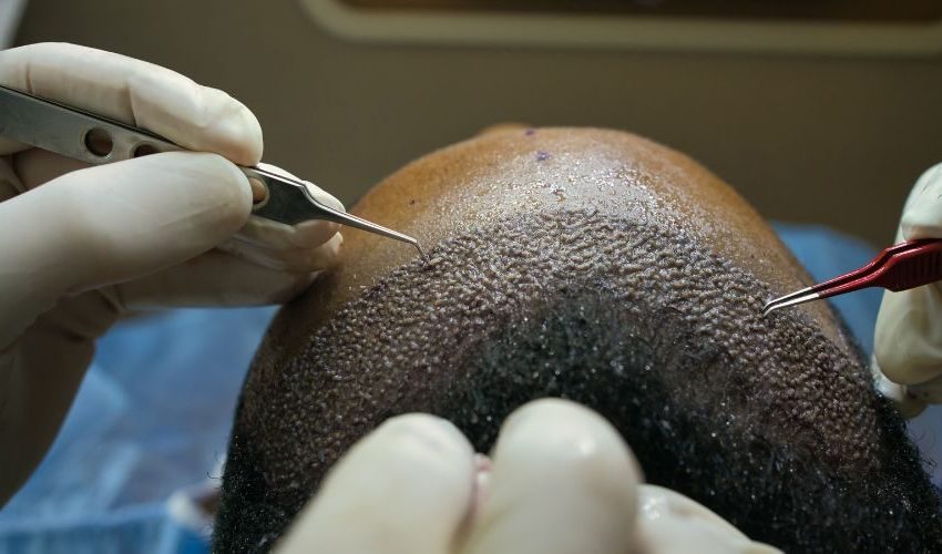  Hair Transplant in Lahore