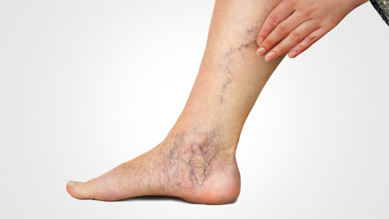  How Can Untreated Varicose Veins Affect Mental Health?