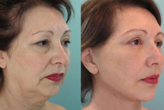  Understanding the Expenses Involved in Mid Facelift Surgery