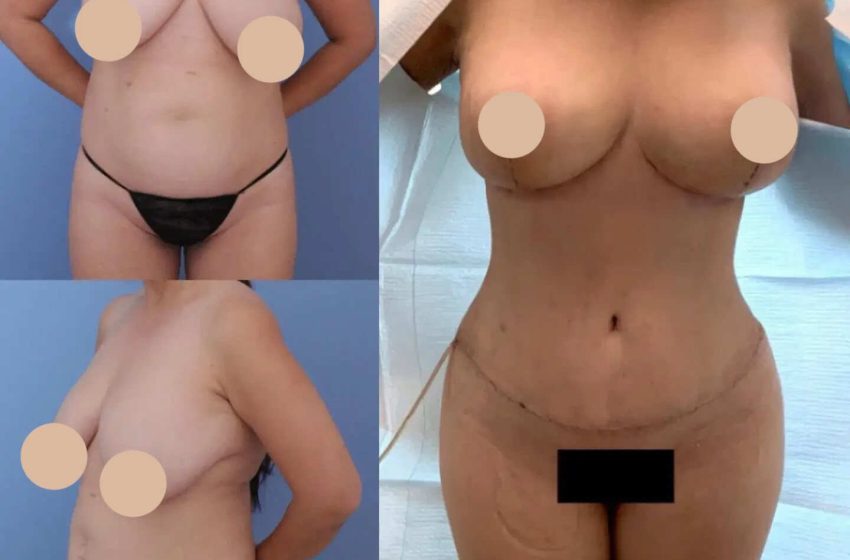  Revision Tummy Tuck Surgery in Dubai: Correcting Previous Procedures