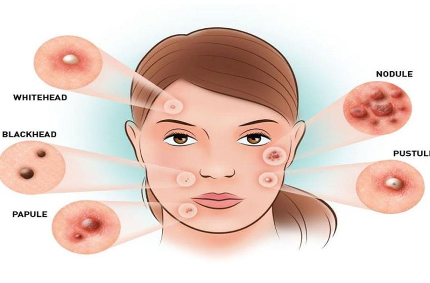  What You Need to Know About Hormonal Acne?