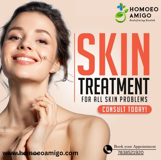  Clear Skin, Naturally: Acne Homeopathic Treatment at Homoeo Amigo