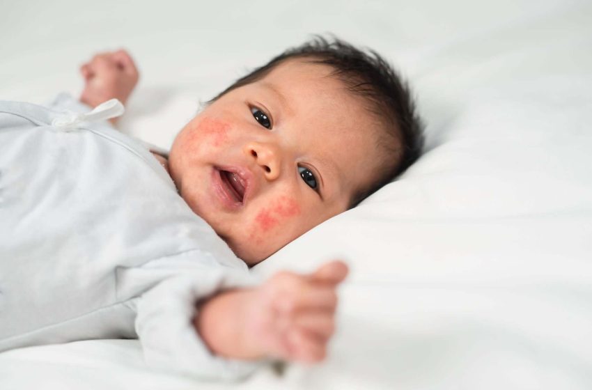  Baby Eczema Vs. Acne: How to Identify Each Condition