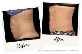 Rejuvenate Your Appearance with PDO Thread Lift in NYC