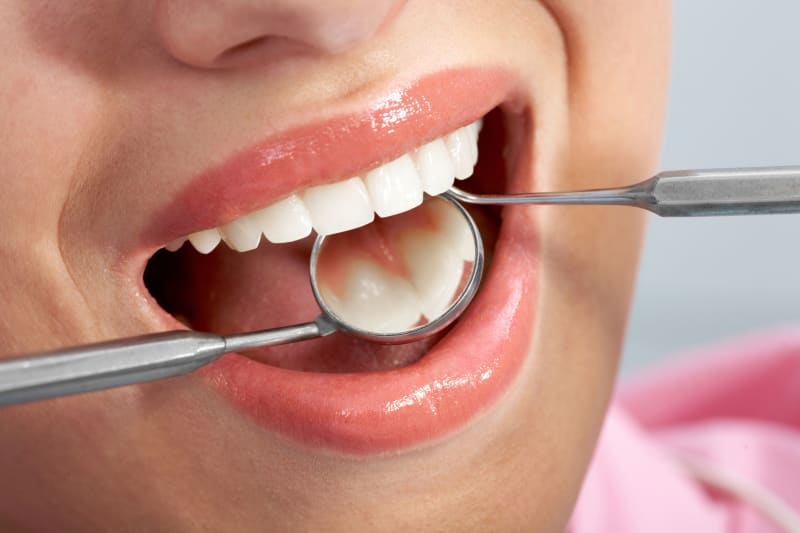  What Are the Benefits of Composite Resin Fillings?