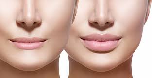  Lip Augmentation with Facial Fat Transfer A Natural Approach