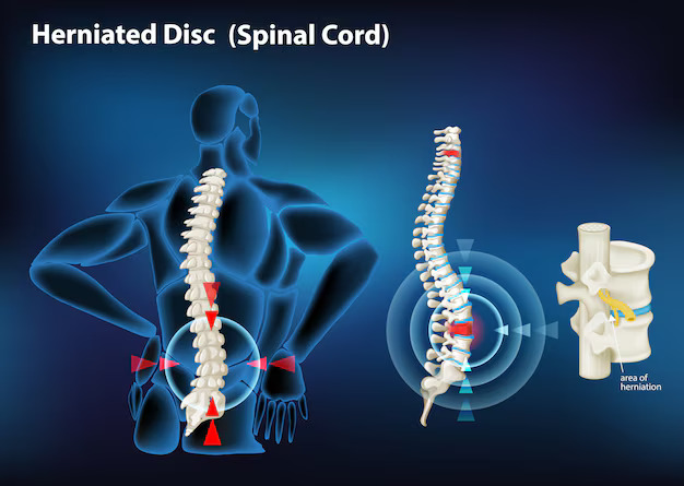  Slipped Disc Treatment Options: What You Need to Know