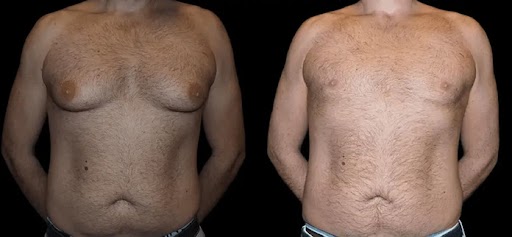 Importance of Nutrition in Optimizing Male Breast Reduction Results