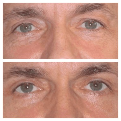  The Role of Genetics in Eye Bags and Fat Accumulation