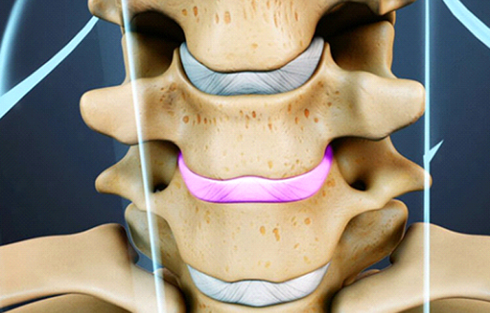  Motion Sparing Neck Surgeries: A Revolutionary Approach to Spine Health