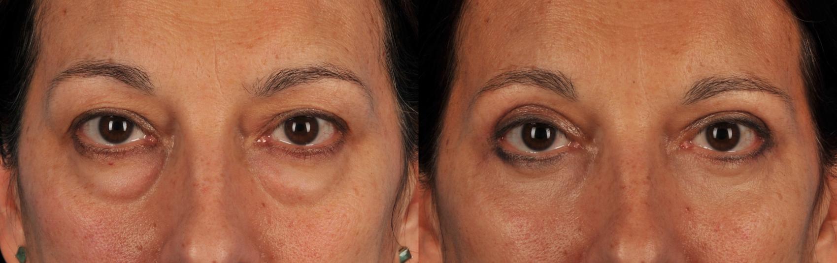 The Evolution of Eyelid Surgery Techniques