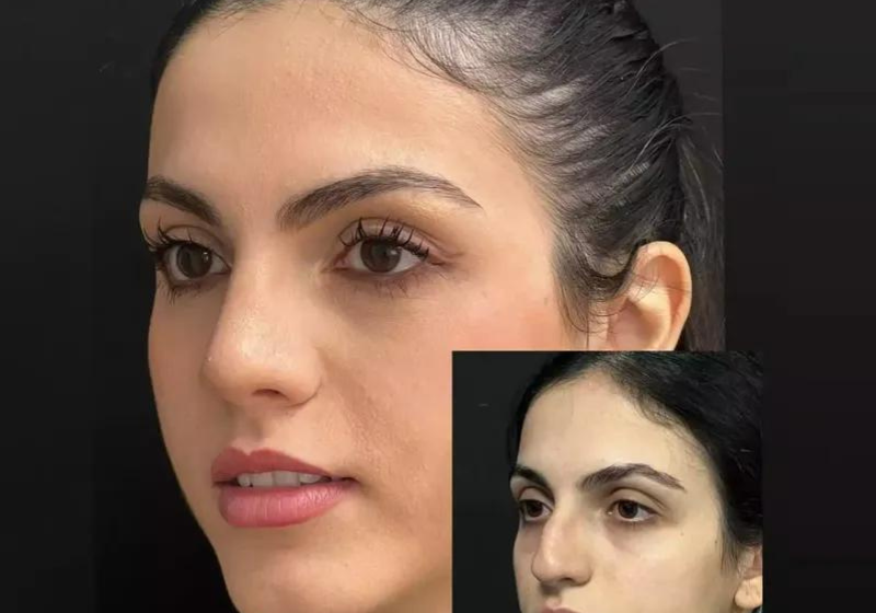  The Impact of Skin on Rhinoplasty Results