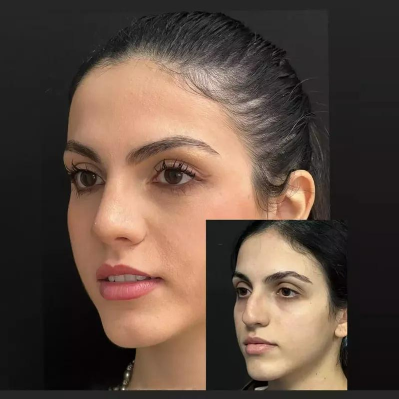 The Impact of Skin on Rhinoplasty Results