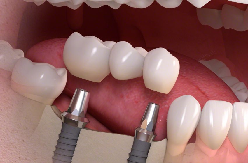  Cosmetic Dentistry and Dental Implants: Achieving the Perfect Smile