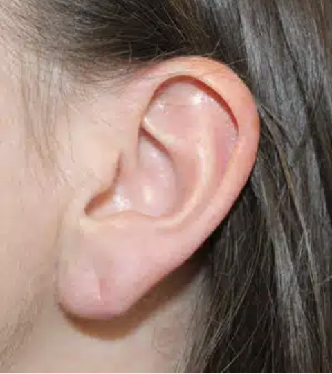  Mastering Ear Reshaping: Your Comprehensive Guide