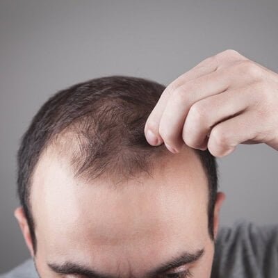  FUE Hair Transplant in Dubai Regain Your Confidence