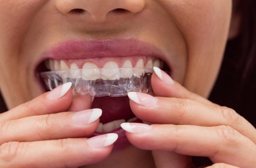  How Does Invisalign Work? A Clear Path to a Beautiful Smile