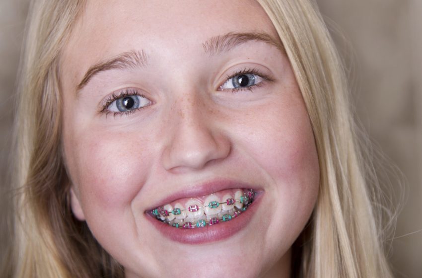  Teeth Braces Cost in Dubai: A Price Comparison