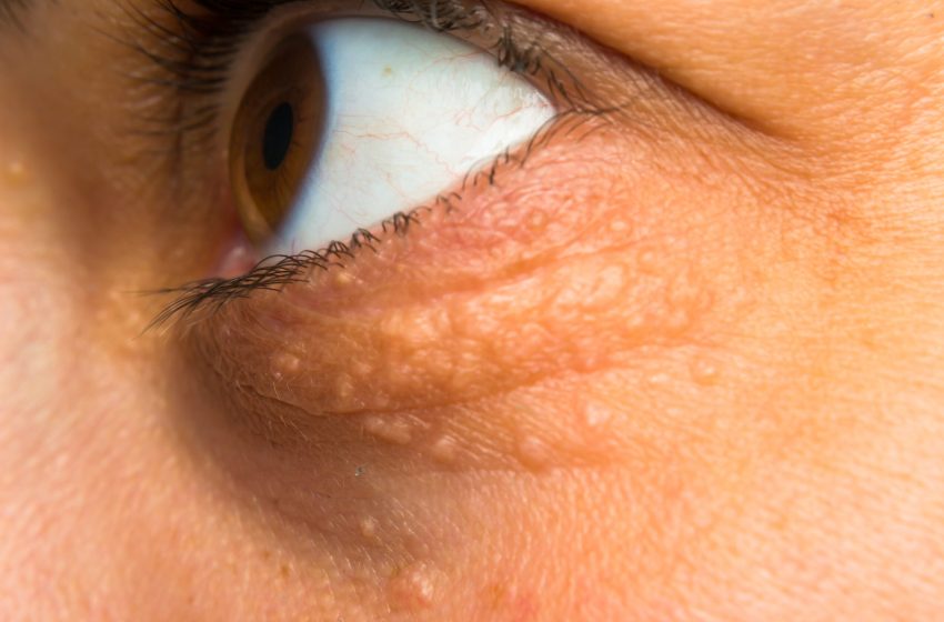  Scar-Free Eyelid Xanthelasma Removal: A Comprehensive Guide