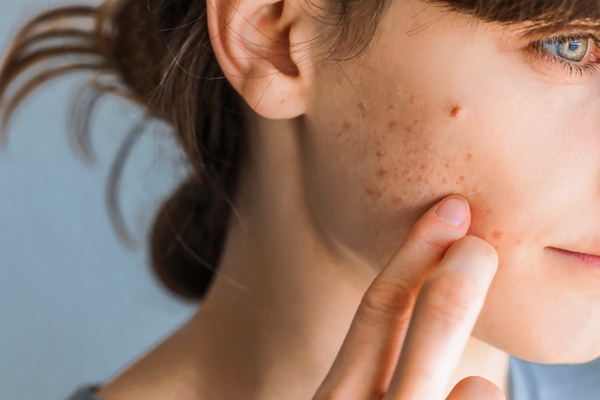 Acne Treatment Essentials: Tips for Achieving Clear, Healthy Skin