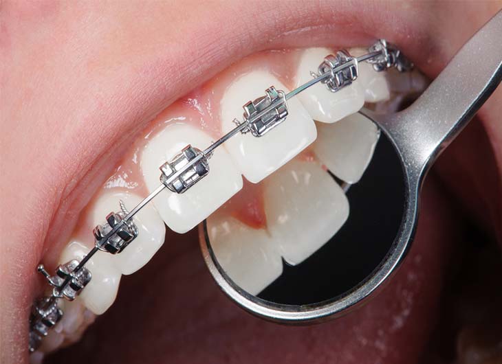  Choosing the Right Teeth Braces Based on Your Budget