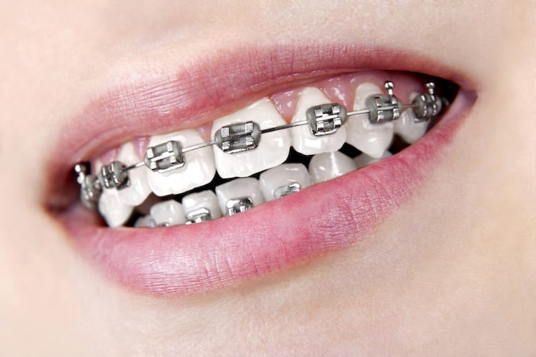  The Psychological Benefits of Teeth Braces: Boost Your Confidence