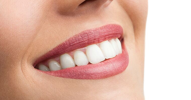  Sparkling Smiles Premier Teeth Whitening Treatments in Dubai