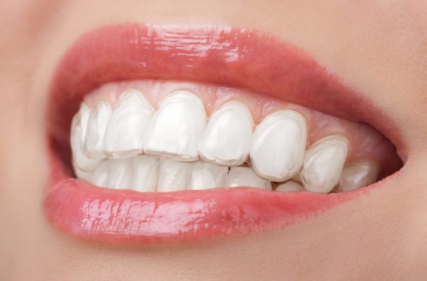  Tips for Maintaining Your Teeth Whitening Results