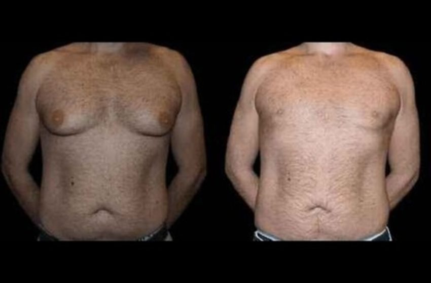  How to Mentally and Physically Prepare for Male Breast Reduction Surgery