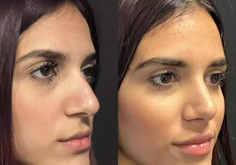  Will Rhinoplasty Affect My Sense of Smell?