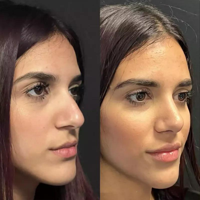 Will Rhinoplasty Affect My Sense of Smell?