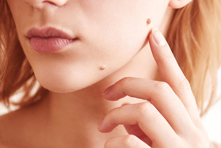  Safe and Effective Skin Tag Removal in Dubai: Procedures Explained