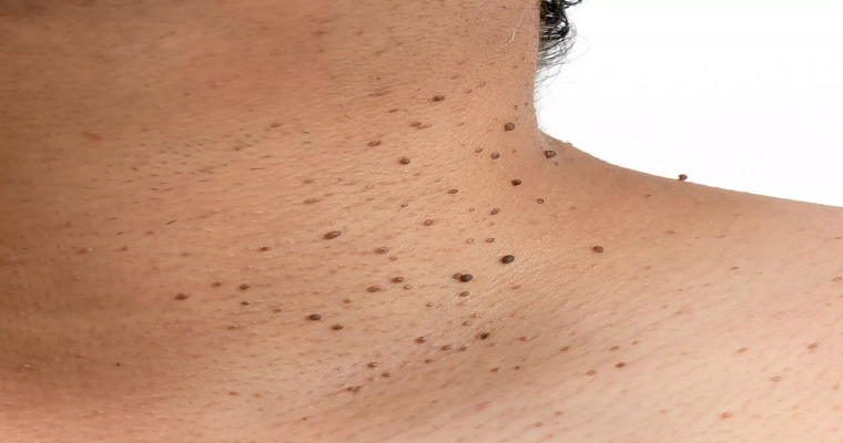  Affordable Skin Tag Removal in Dubai: Price Breakdown and Options