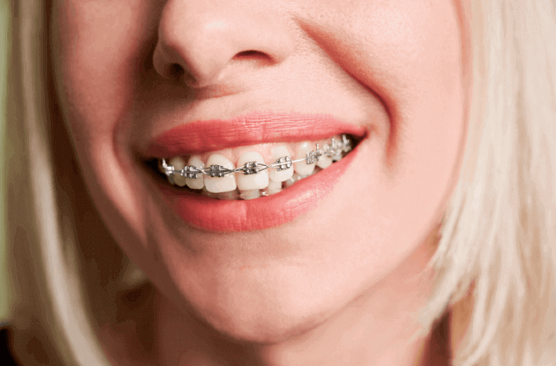  Understanding Teeth Braces Cost in Dubai