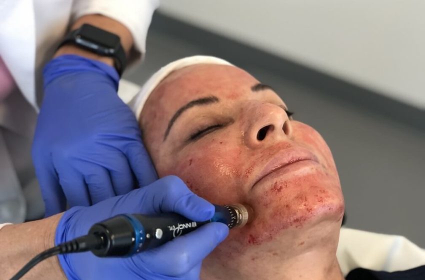  The Vampire Facelift: A Natural Path to Youthful Skin