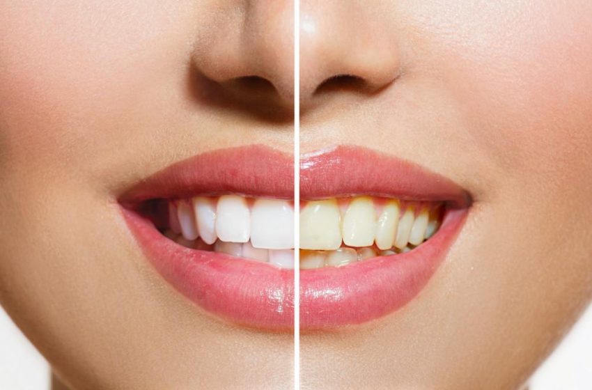  Smile Bright: Advanced Teeth Whitening Solutions