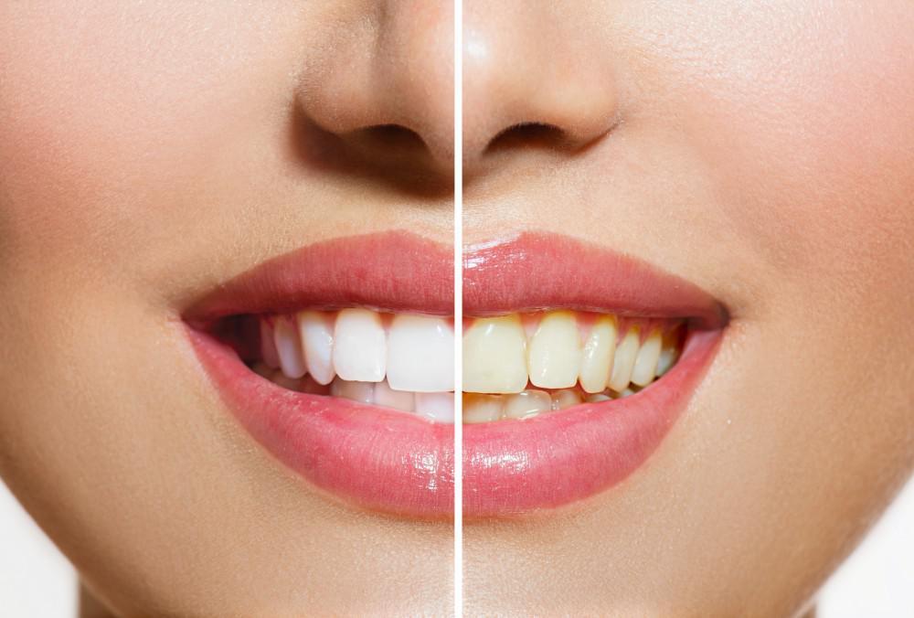 Smile Bright: Advanced Teeth Whitening Solutions