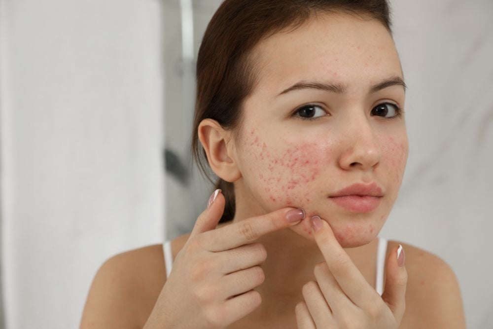 Reclaim Your Skin: The Best Acne Treatments to Explore