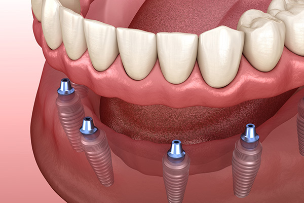 The Role of Bone Health in Successful Dental Implant Placement