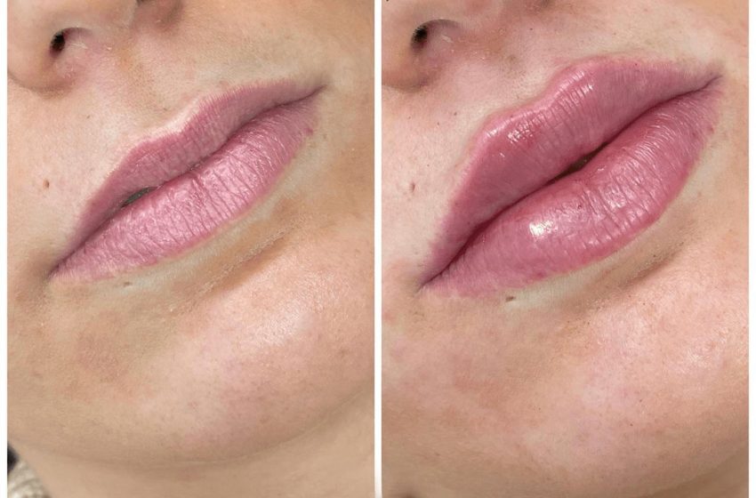  Juvederm Fillers Injections for Marionette Lines: A Solution for a Youthful Smile in Dubai