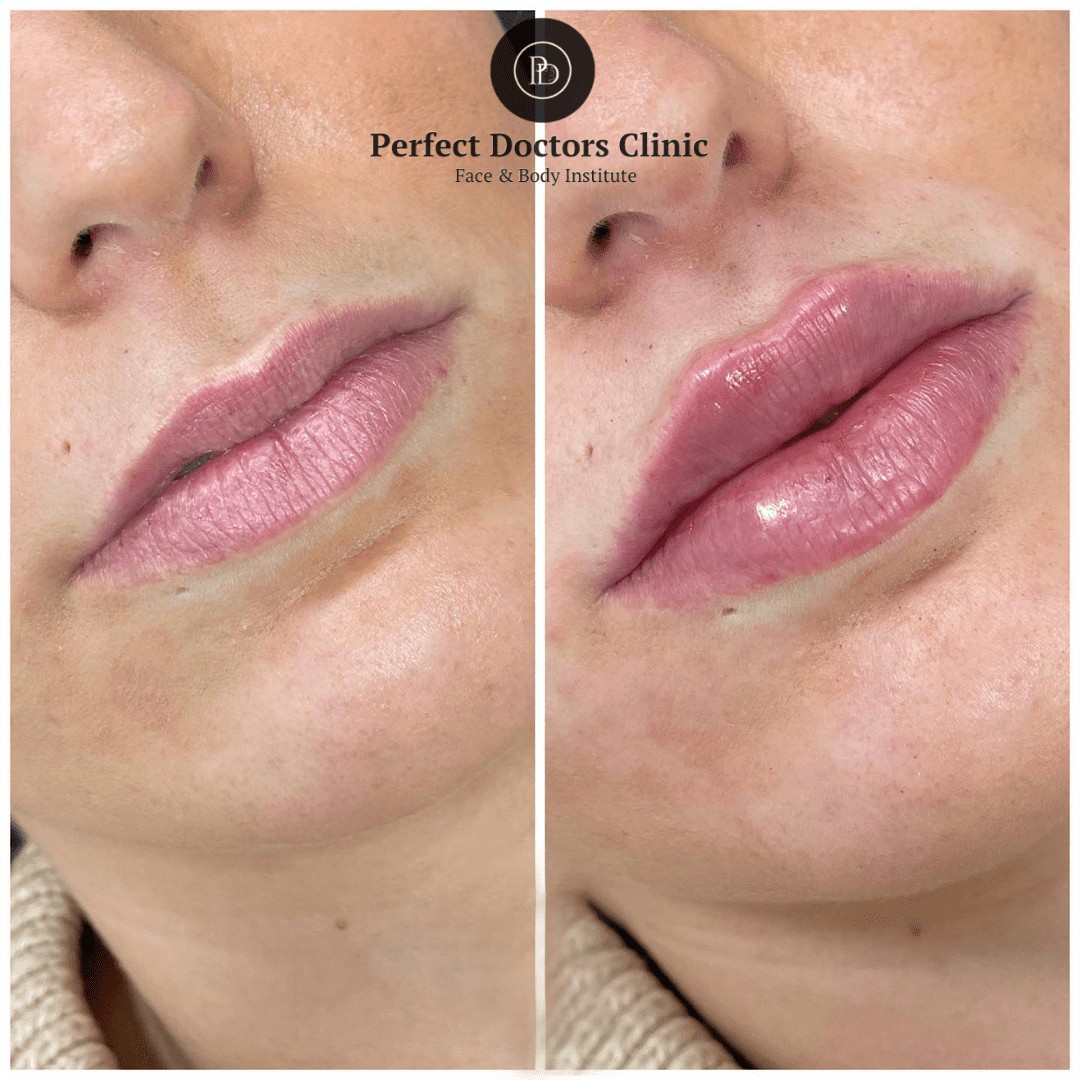 Juvederm Fillers Injections for Marionette Lines: A Solution for a Youthful Smile in Dubai