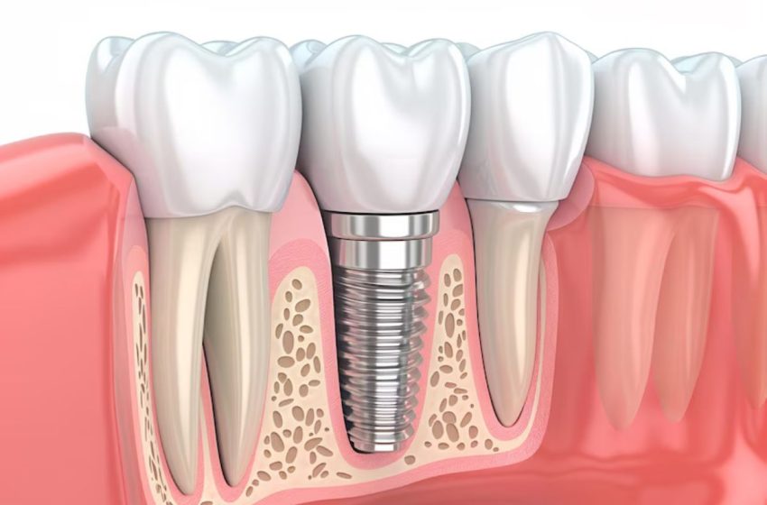  Dental Implants for Seniors: Restoring Smiles at Any Age