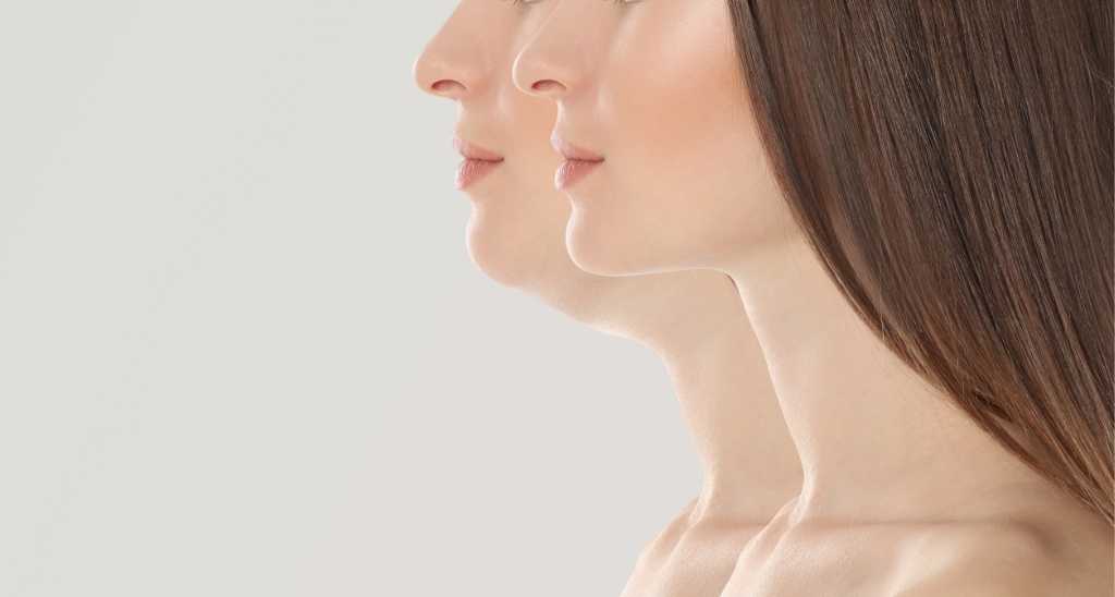 Get Rid of Your Double Chin: Liposuction Techniques and Benefits