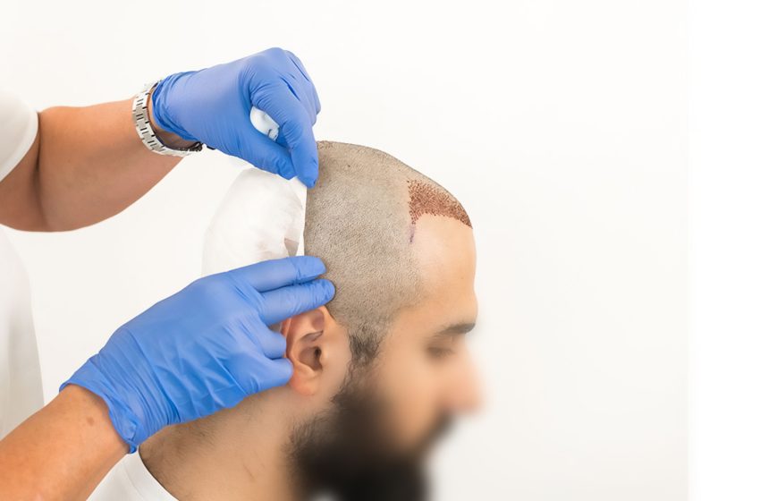  Hair Transplant Cost: What to Expect This Year