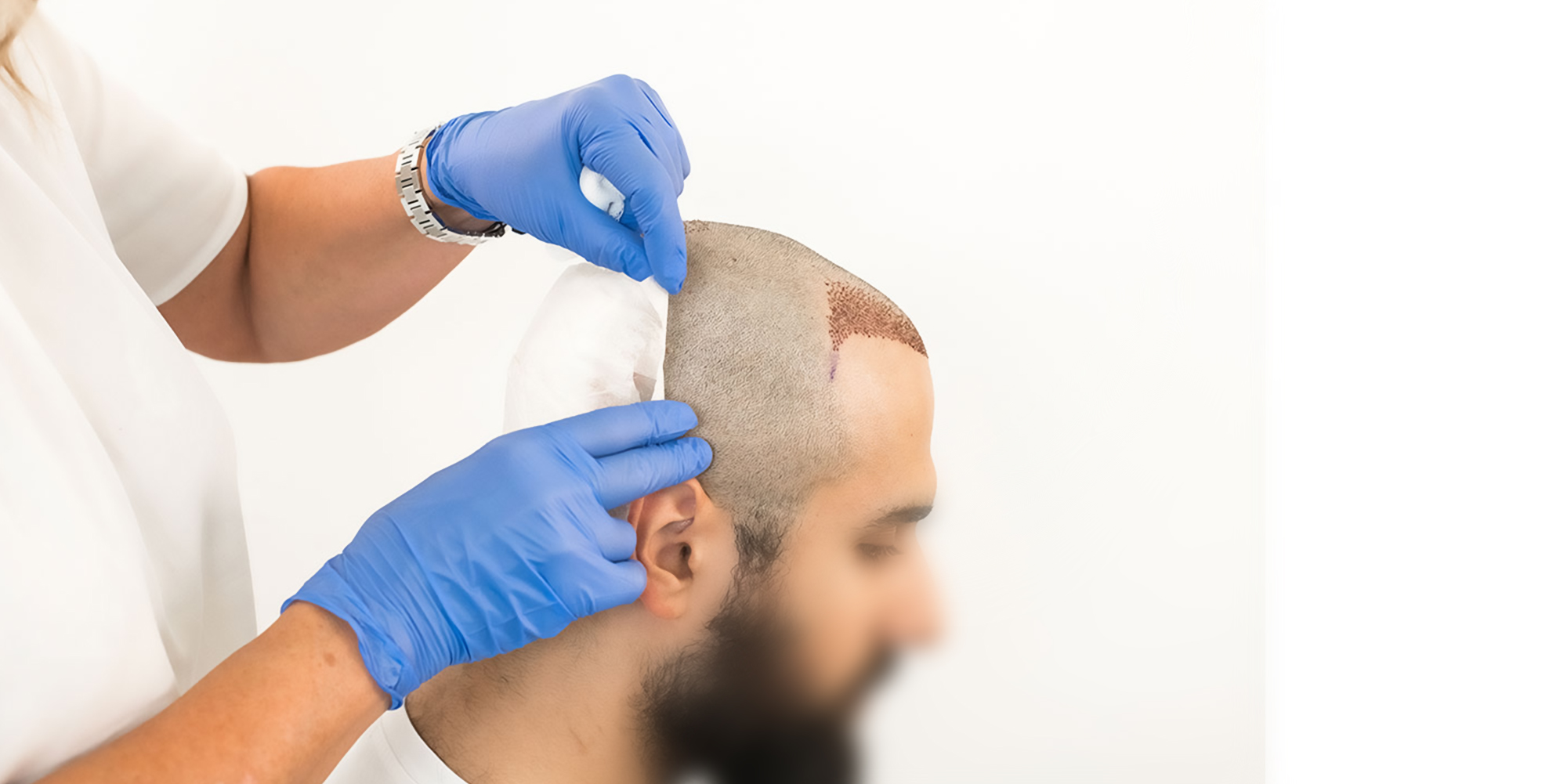 Hair Transplant Costs in Dubai: What to Expect