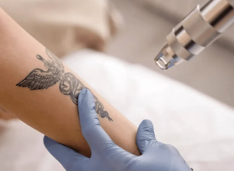  Ink-Free Future: Navigating Life After Laser Tattoo Removal