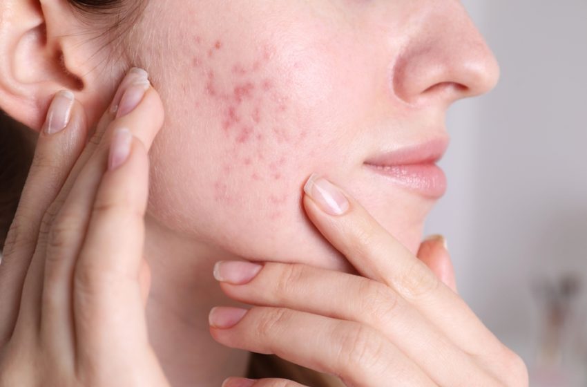  Revitalize Your Skin with Targeted Pimples Treatment